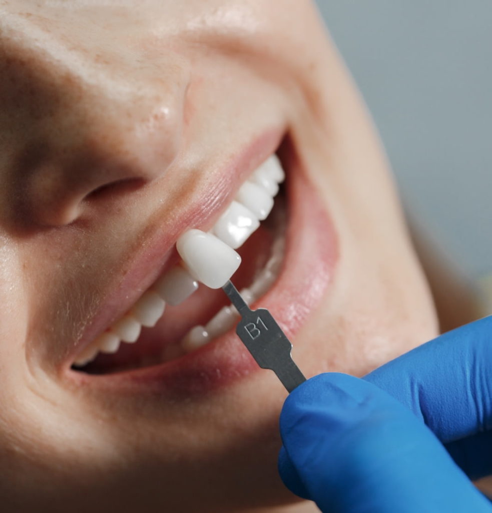Smile Dental Clinic Dental Veneer 01