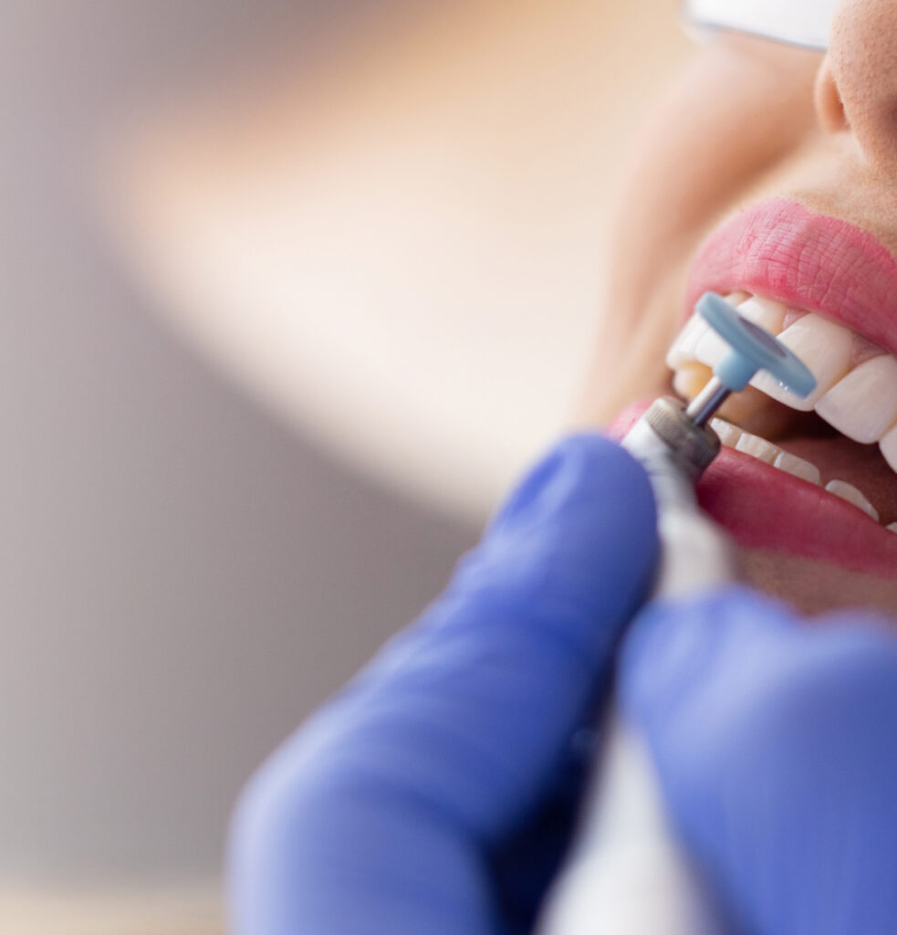 Smile Clinic Polishing Final Step